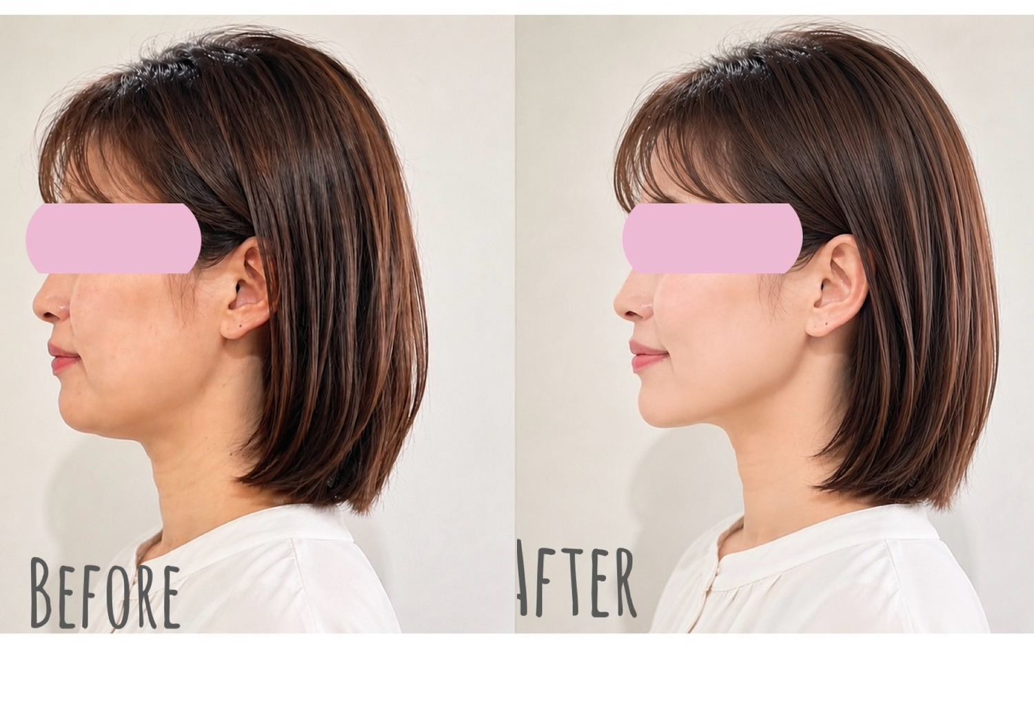 小顔・フェイスラインケアのBefore/After