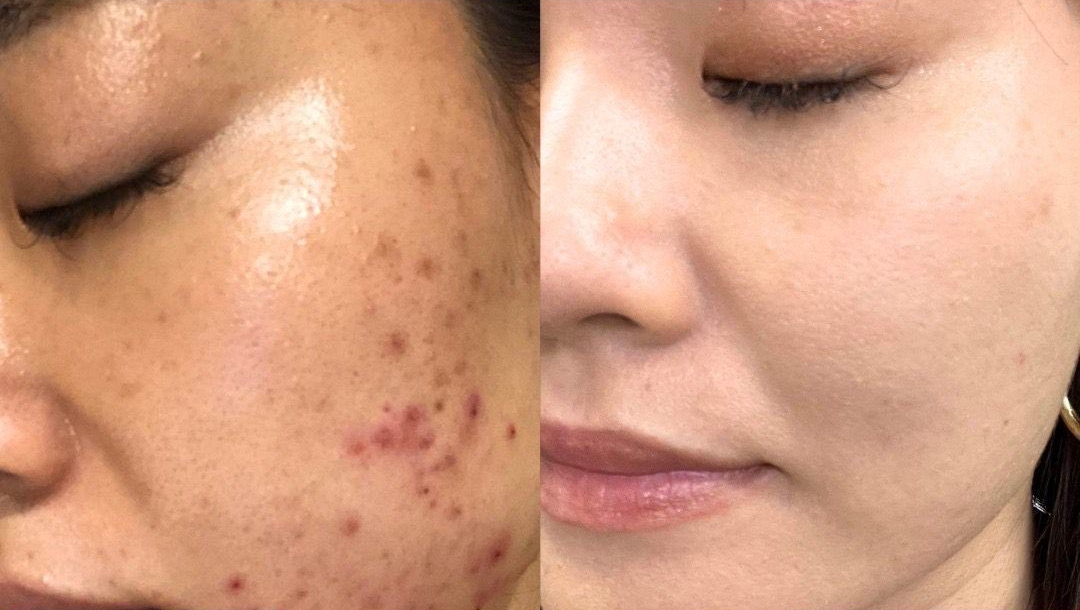 赤み・肌質改善ケアのBefore/After